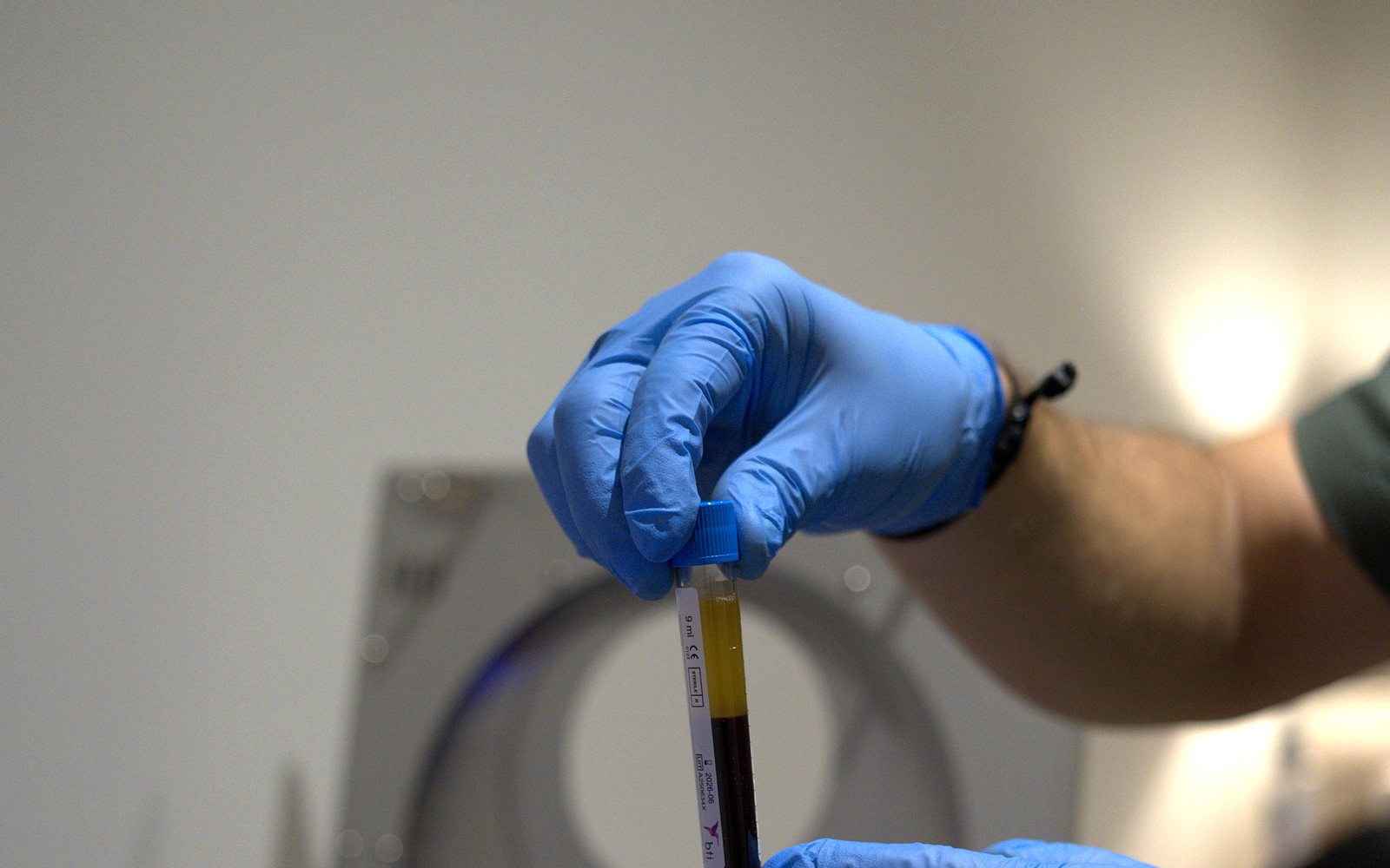 Plasma rico en plaquetas (PRP) tras el centrifugado